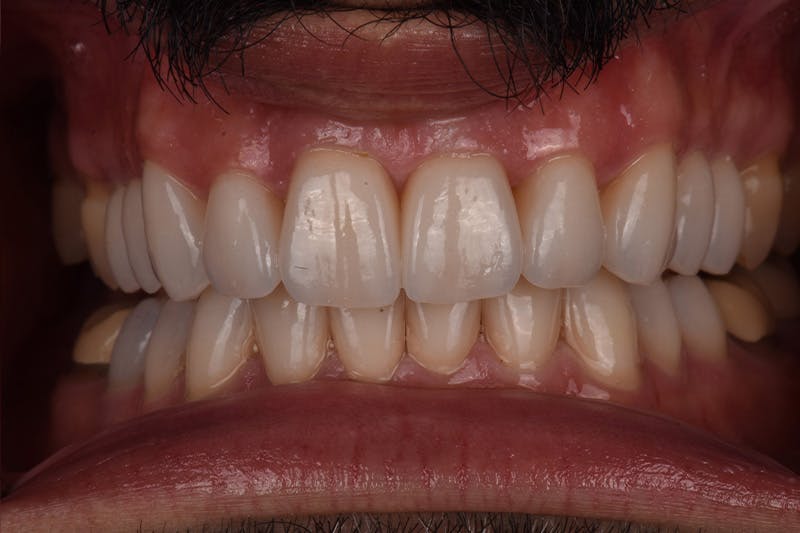 Patient Smile Before & After Gallery - Patient 205656 - Image 4