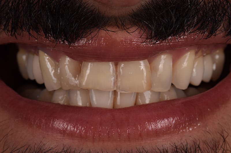 Patient Smile Before & After Gallery - Patient 205656 - Image 5