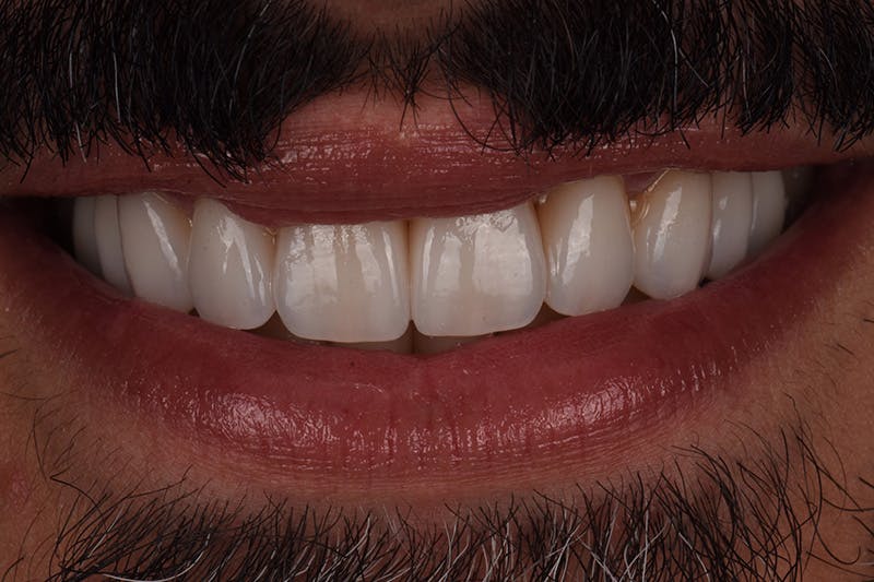 Patient Smile Before & After Gallery - Patient 205656 - Image 6
