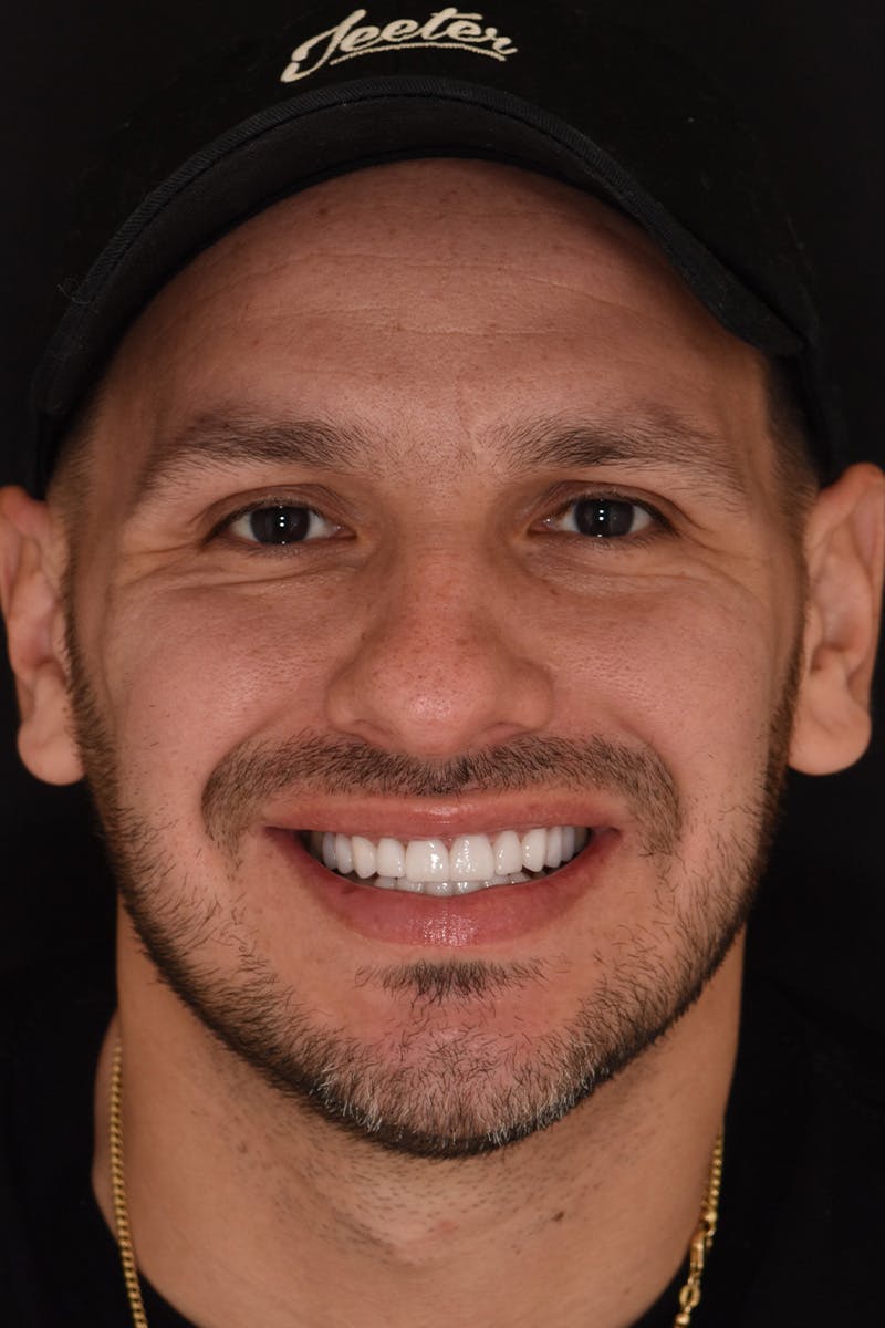 Patient Smile Before & After Gallery - Patient 370940 - Image 2