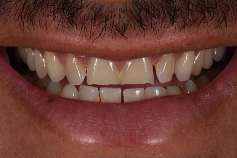 Patient Smile Before & After Gallery - Patient 370940 - Image 3