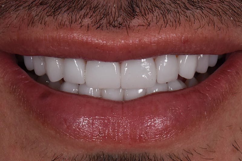 Patient Smile Before & After Gallery - Patient 370940 - Image 4