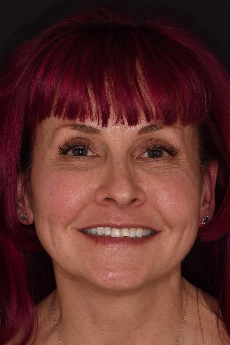 Patient Smile Before & After Gallery - Patient 287704 - Image 1