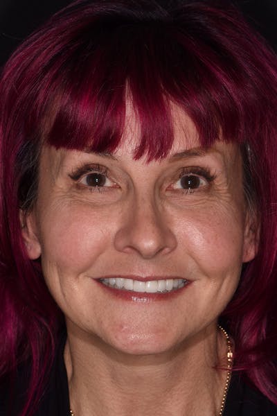 Patient Smile Before & After Gallery - Patient 287704 - Image 2