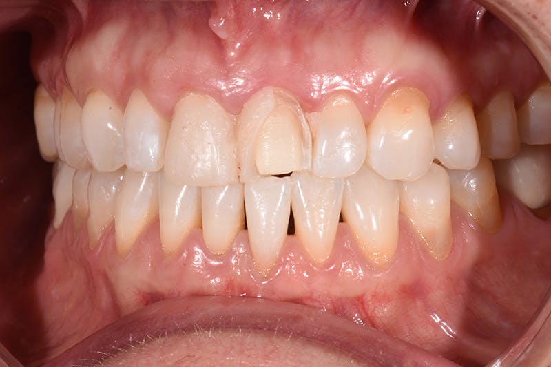 Patient Smile Before & After Gallery - Patient 287704 - Image 3