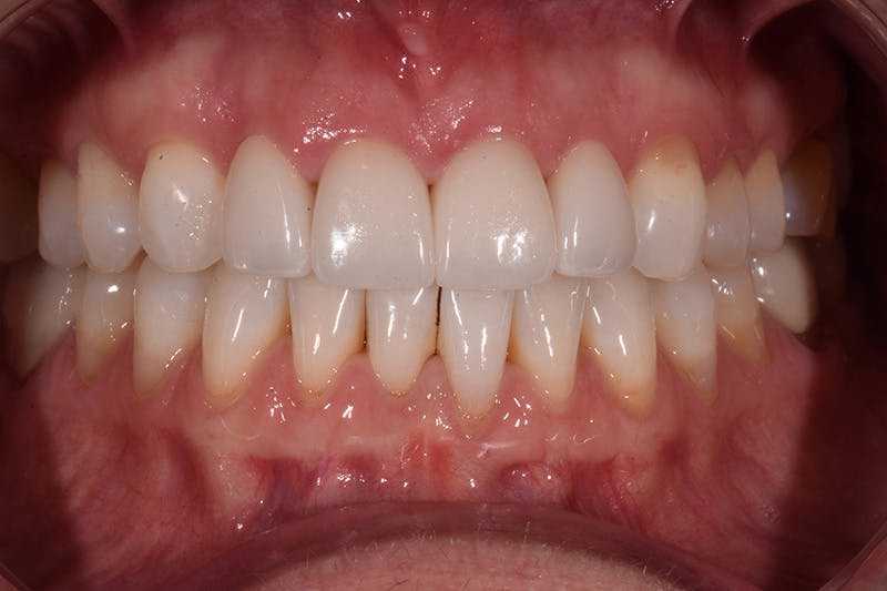 Patient Smile Before & After Gallery - Patient 287704 - Image 4