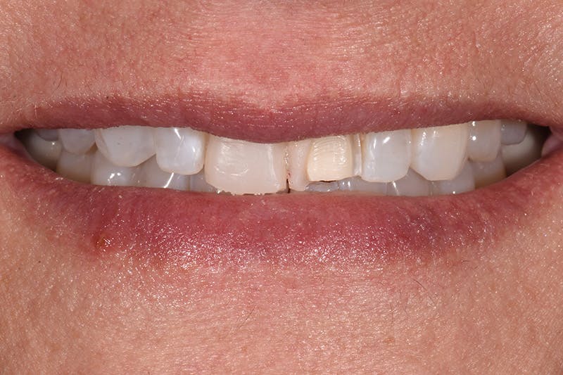 Patient Smile Before & After Gallery - Patient 287704 - Image 5
