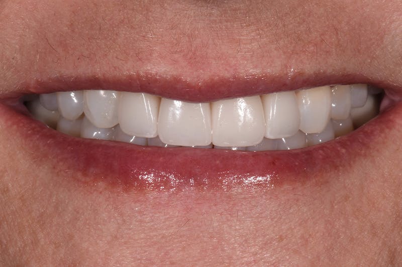Patient Smile Before & After Gallery - Patient 287704 - Image 6