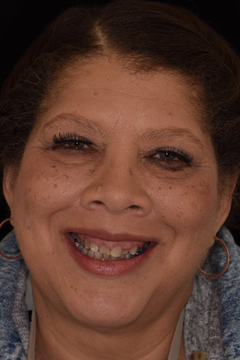 Patient Smile Before & After Gallery - Patient 157076 - Image 1