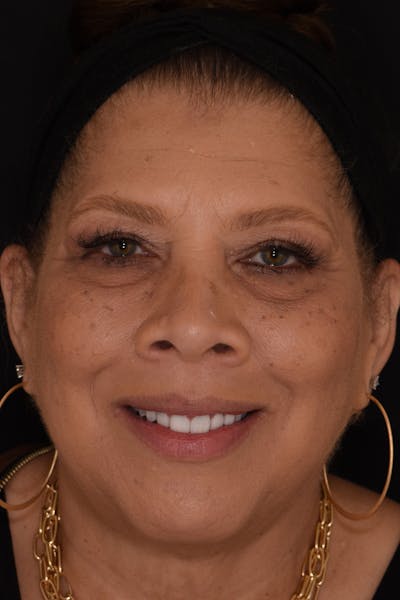 Patient Smile Before & After Gallery - Patient 157076 - Image 2