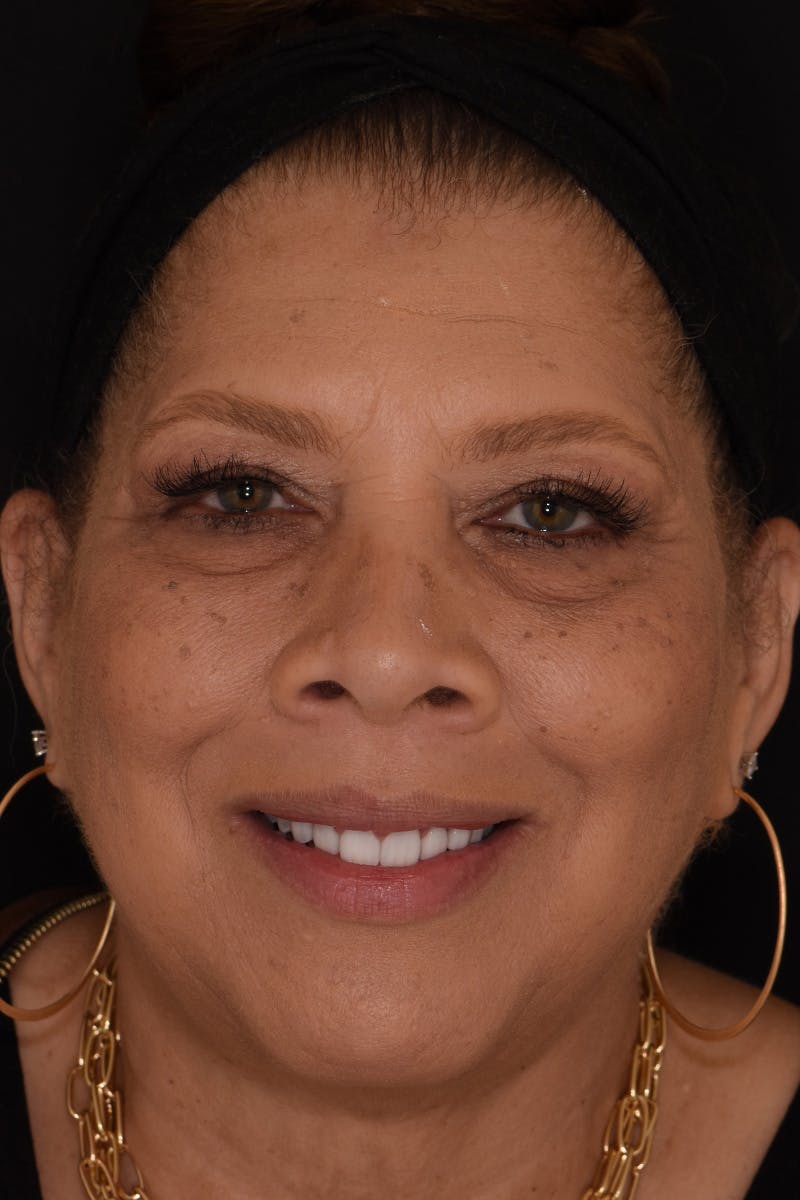 Patient Smile Before & After Gallery - Patient 157076 - Image 2