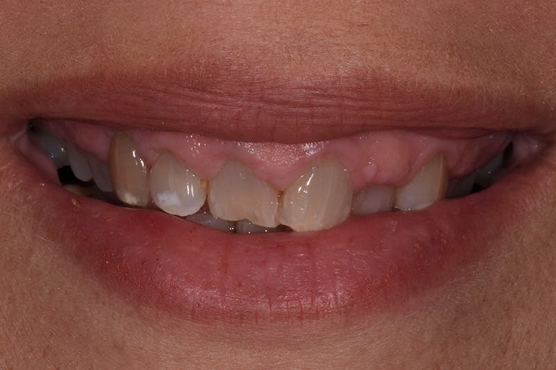 Patient Smile Before & After Gallery - Patient 157076 - Image 3