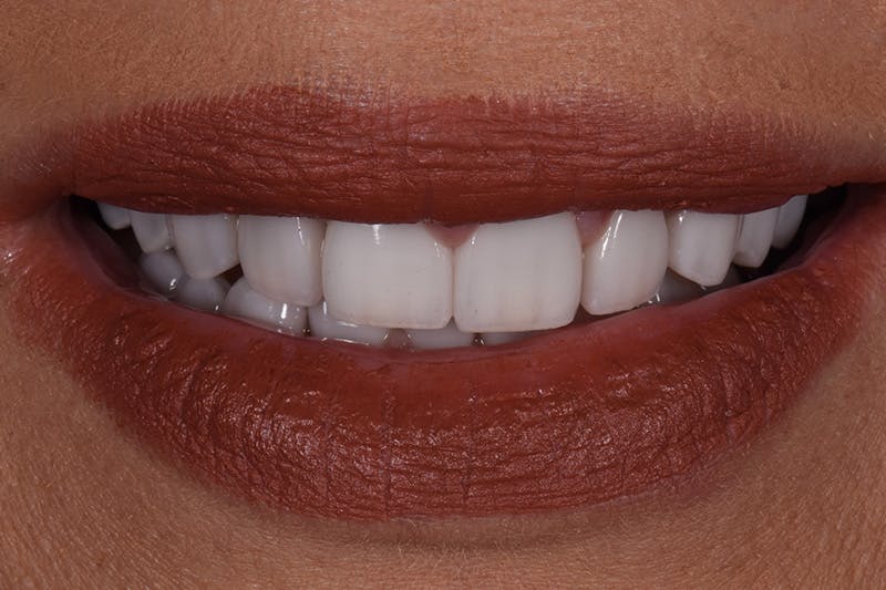 Patient Smile Before & After Gallery - Patient 157076 - Image 4