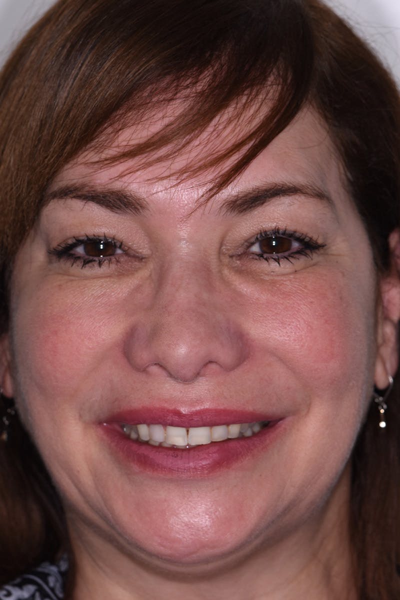 Patient Smile Before & After Gallery - Patient 311445 - Image 1