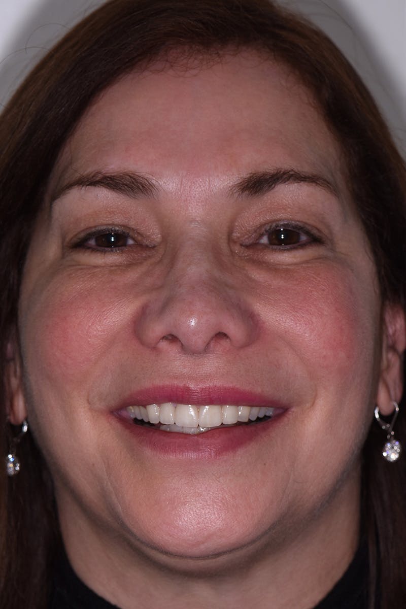 Patient Smile Before & After Gallery - Patient 311445 - Image 2