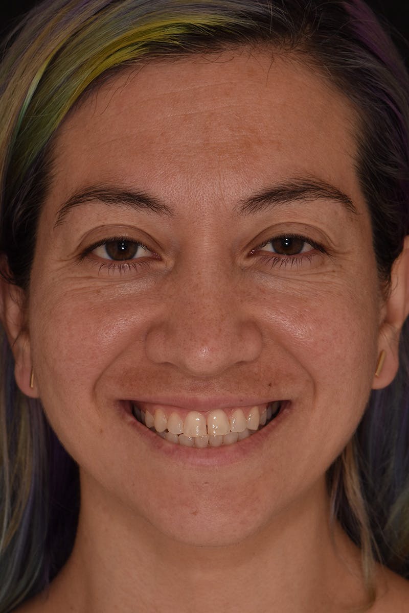 Patient Smile Before & After Gallery - Patient 143914 - Image 1