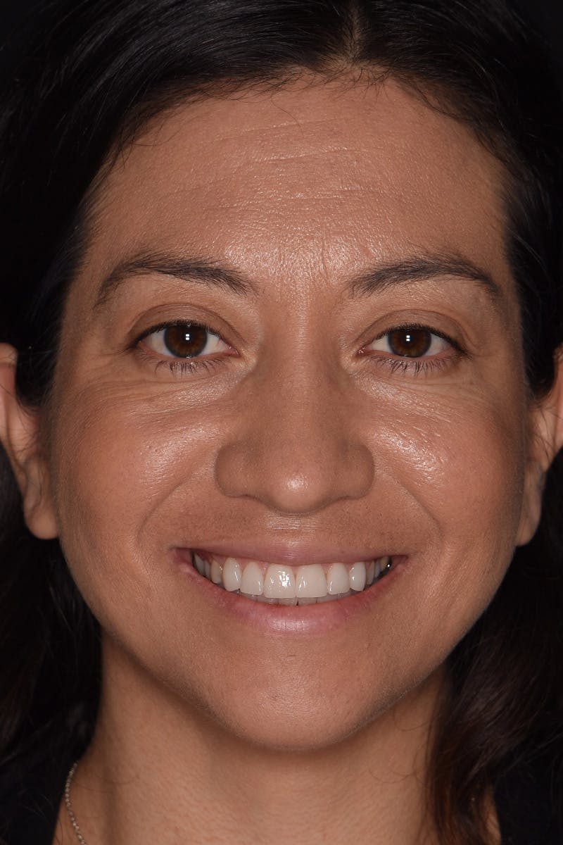 Patient Smile Before & After Gallery - Patient 143914 - Image 2