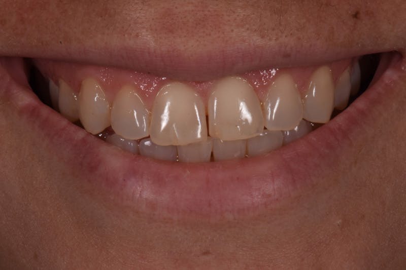 Patient Smile Before & After Gallery - Patient 143914 - Image 3