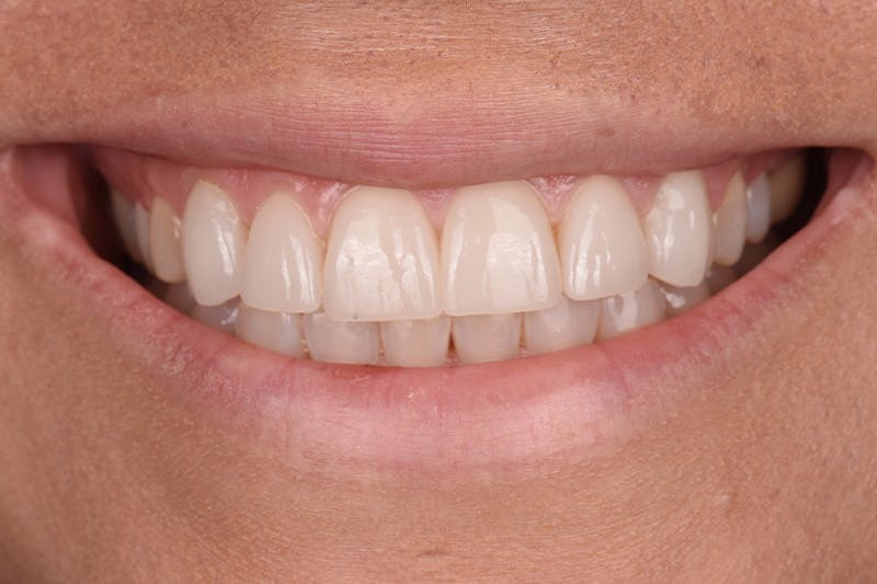 Patient Smile Before & After Gallery - Patient 143914 - Image 4