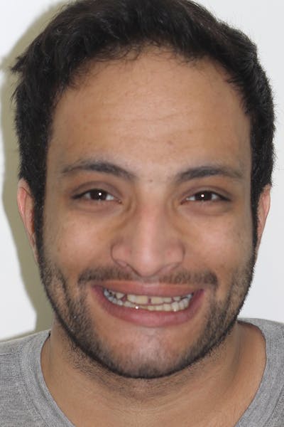 Patient Smile Before & After Gallery - Patient 241189 - Image 1