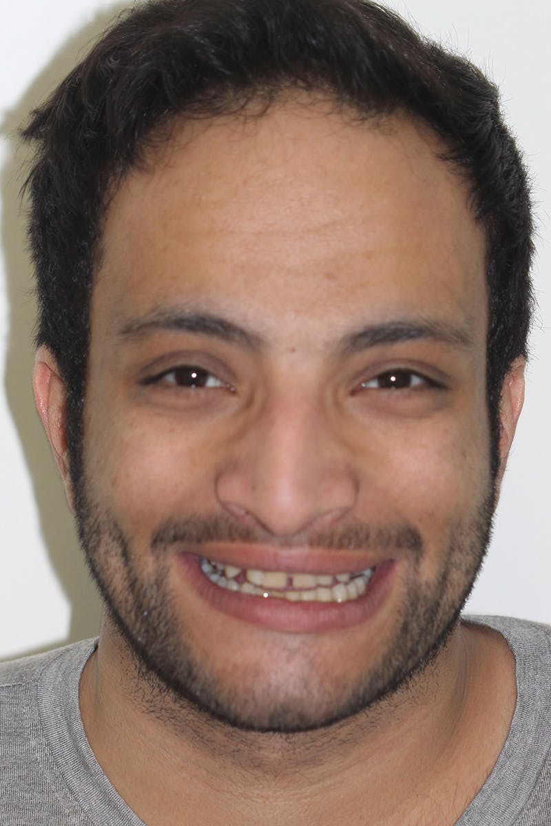 Patient Smile Before & After Gallery - Patient 241189 - Image 1