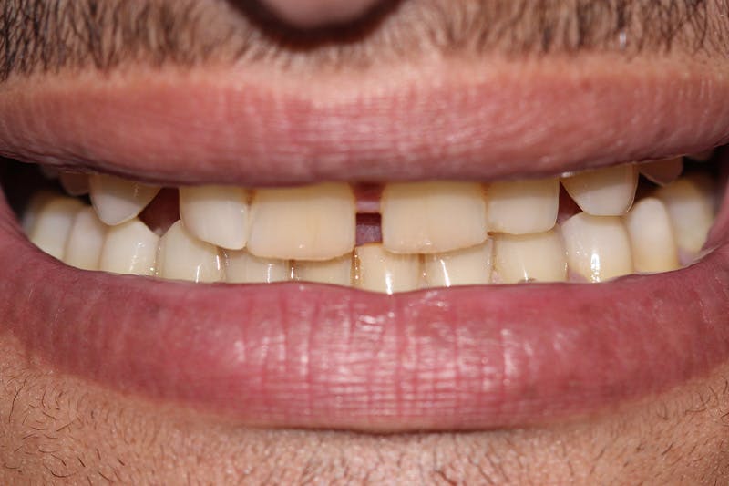 Patient Smile Before & After Gallery - Patient 241189 - Image 3