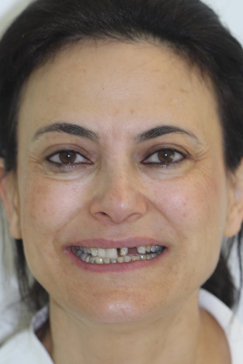 Patient Smile Before & After Gallery - Patient 109986 - Image 1