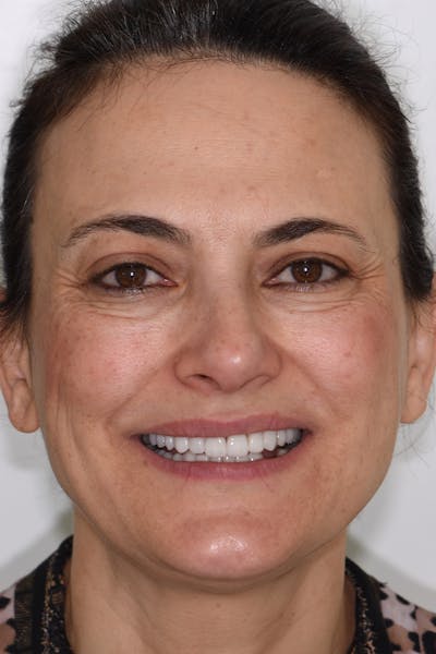 Patient Smile Before & After Gallery - Patient 109986 - Image 2