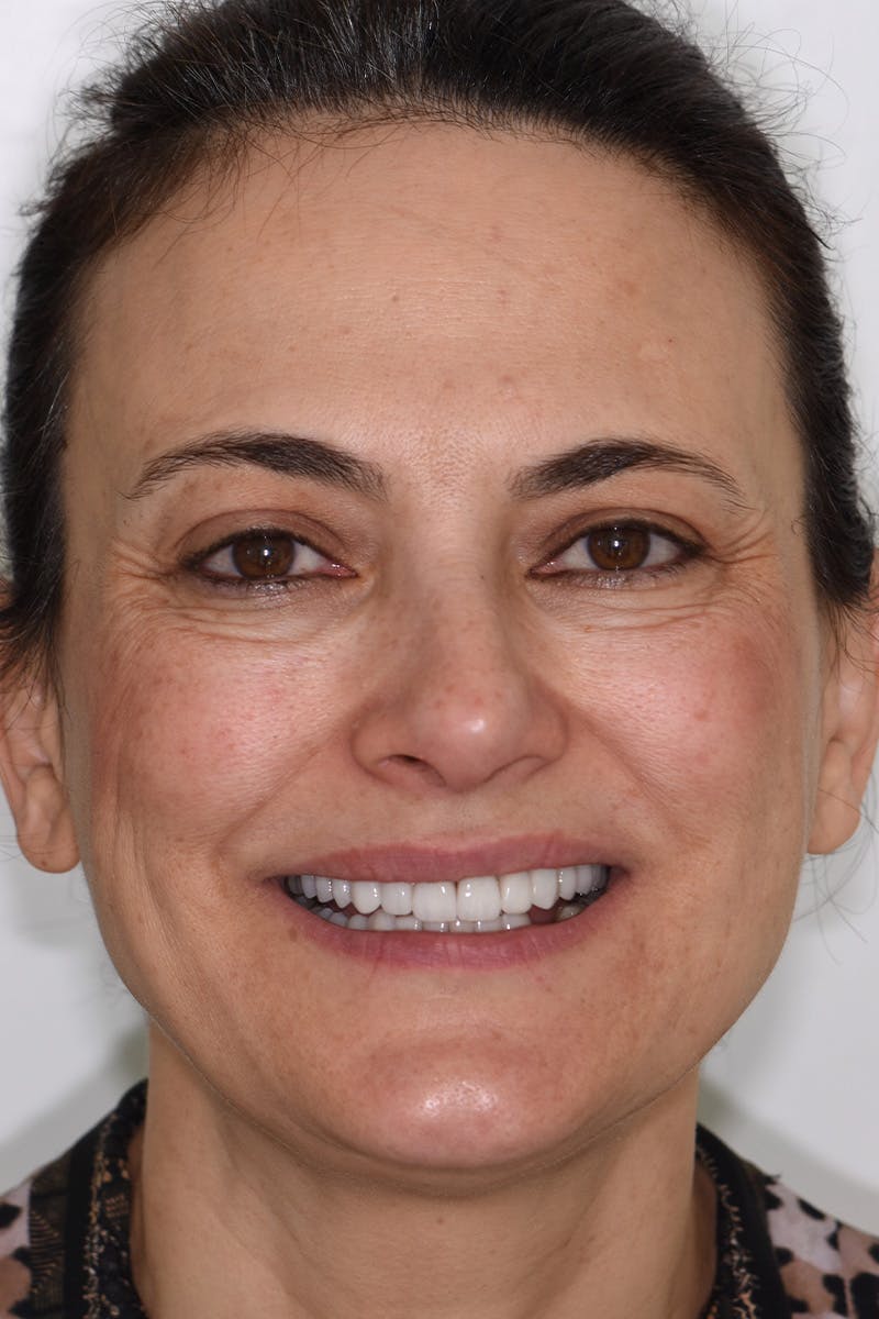 Patient Smile Before & After Gallery - Patient 109986 - Image 2