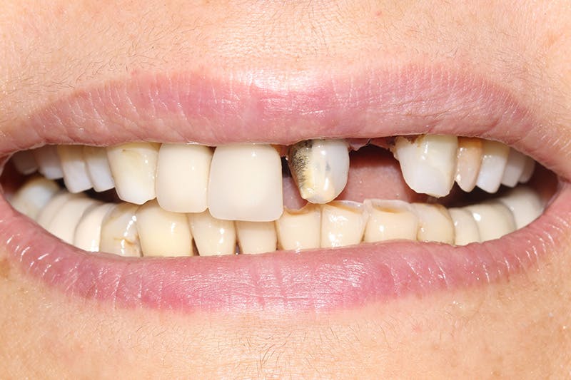 Patient Smile Before & After Gallery - Patient 109986 - Image 3
