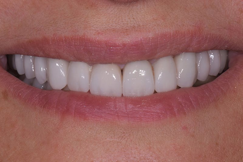 Patient Smile Before & After Gallery - Patient 109986 - Image 4