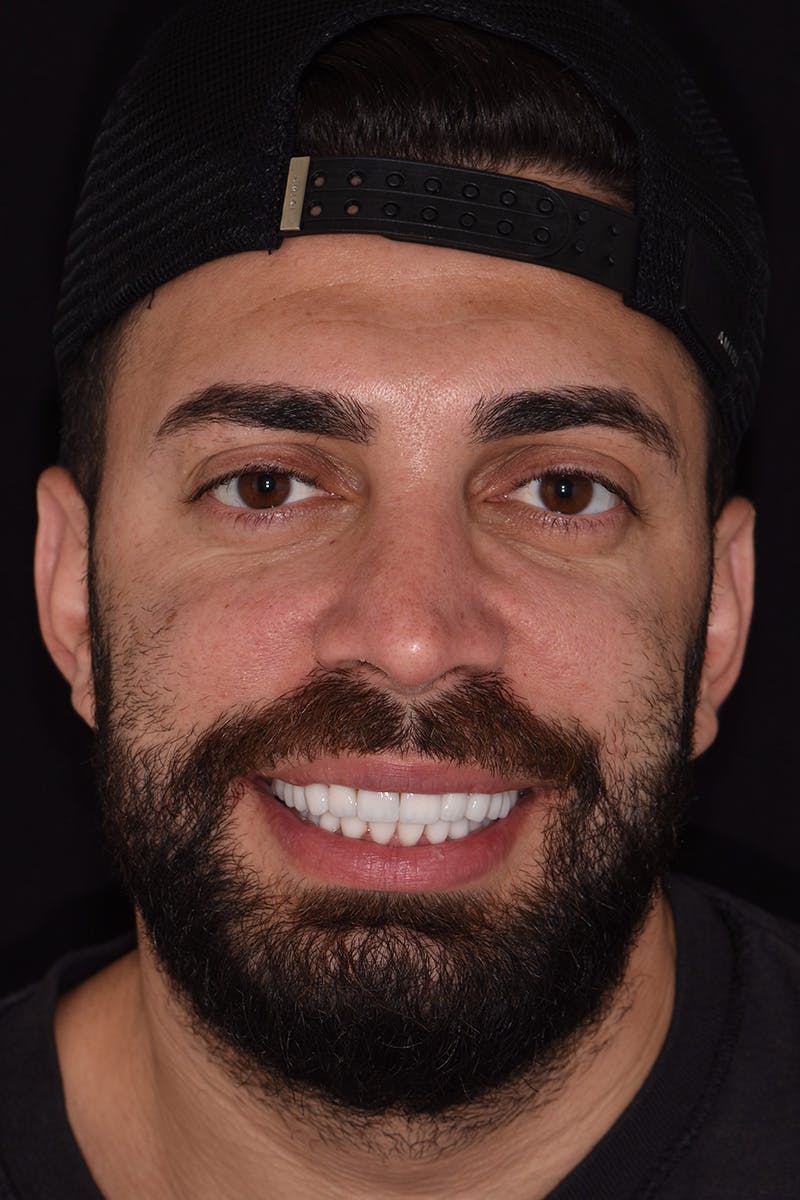 Patient Smile Before & After Gallery - Patient 579480 - Image 2