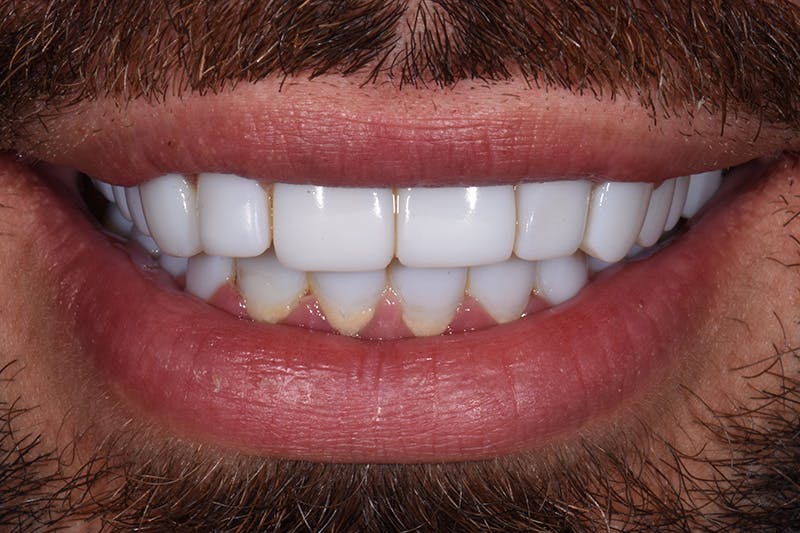 Patient Smile Before & After Gallery - Patient 579480 - Image 3
