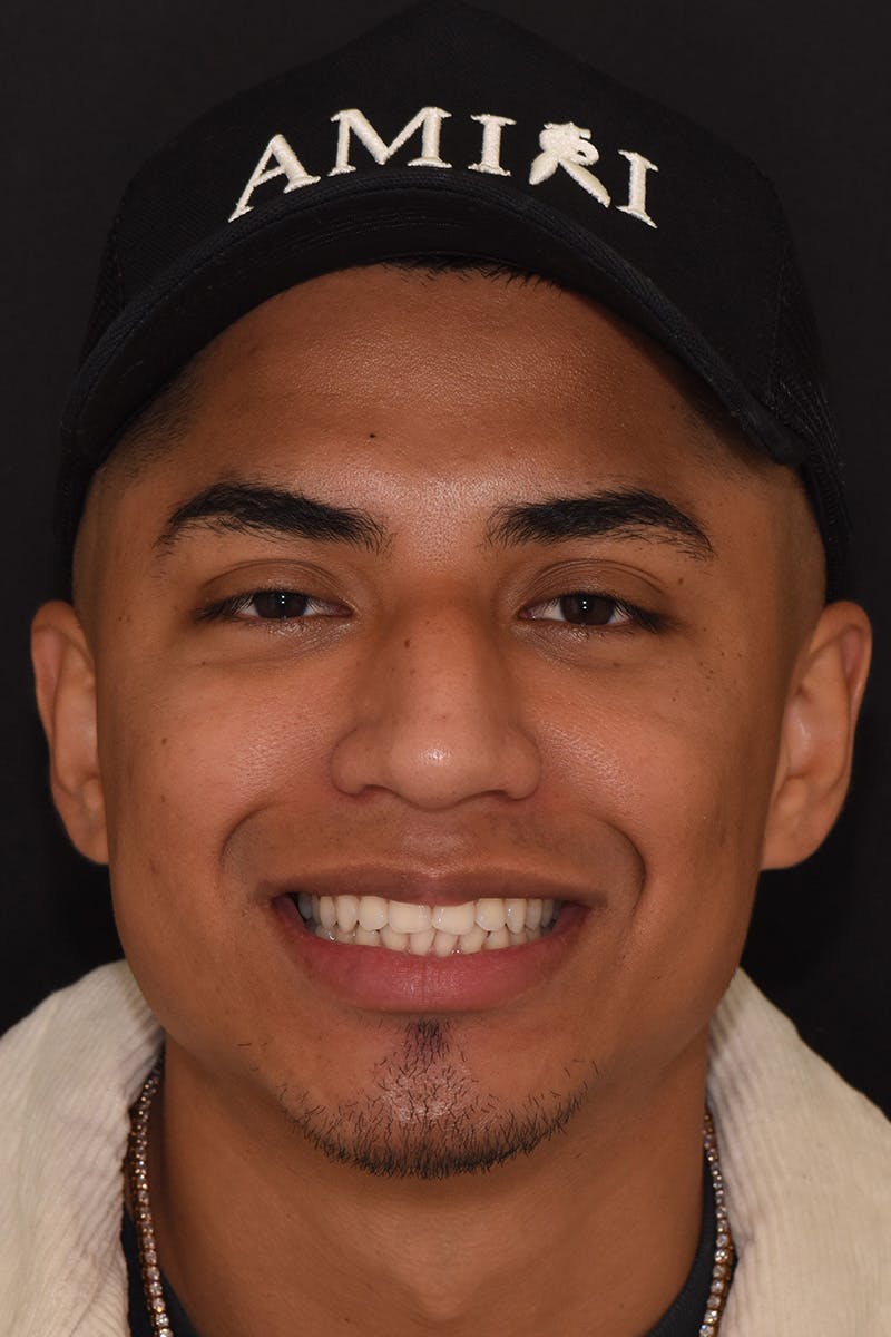 Patient Smile Before & After Gallery - Patient 687251 - Image 1