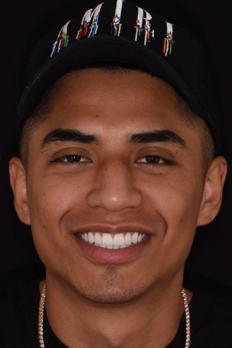 Patient Smile Before & After Gallery - Patient 687251 - Image 2