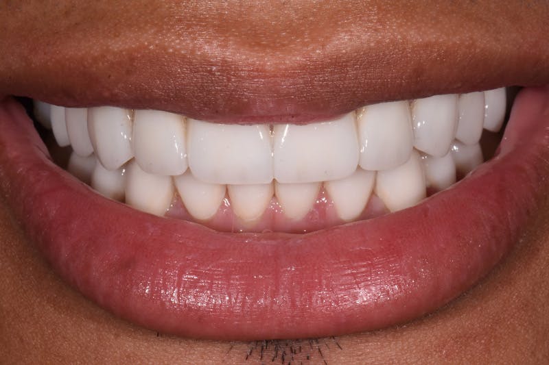 Patient Smile Before & After Gallery - Patient 687251 - Image 4