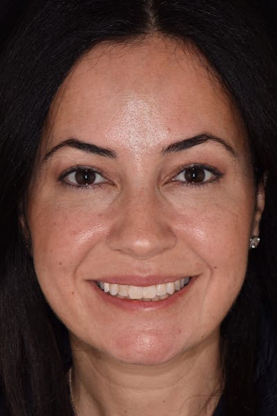 Patient Smile Before & After Gallery - Patient 704129 - Image 1