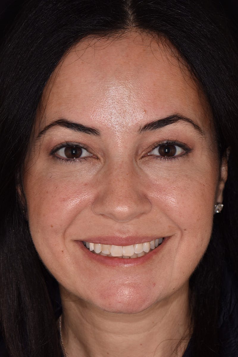 Patient Smile Before & After Gallery - Patient 704129 - Image 1