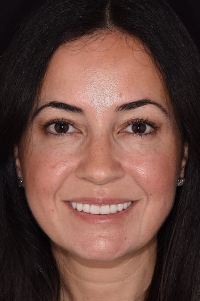 Patient Smile Before & After Gallery - Patient 704129 - Image 2