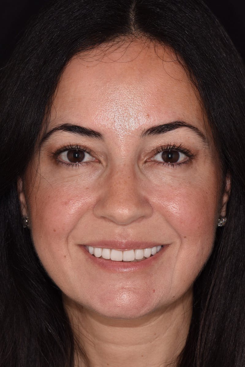 Patient Smile Before & After Gallery - Patient 704129 - Image 2