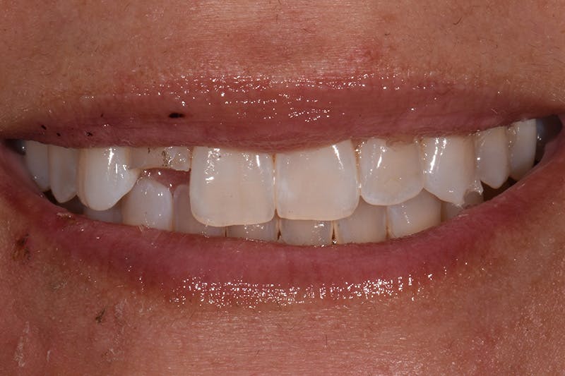 Patient Smile Before & After Gallery - Patient 704129 - Image 3