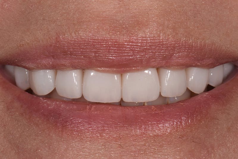 Patient Smile Before & After Gallery - Patient 704129 - Image 4