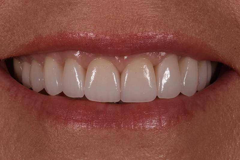 Patient Smile Before & After Gallery - Patient 361250 - Image 4