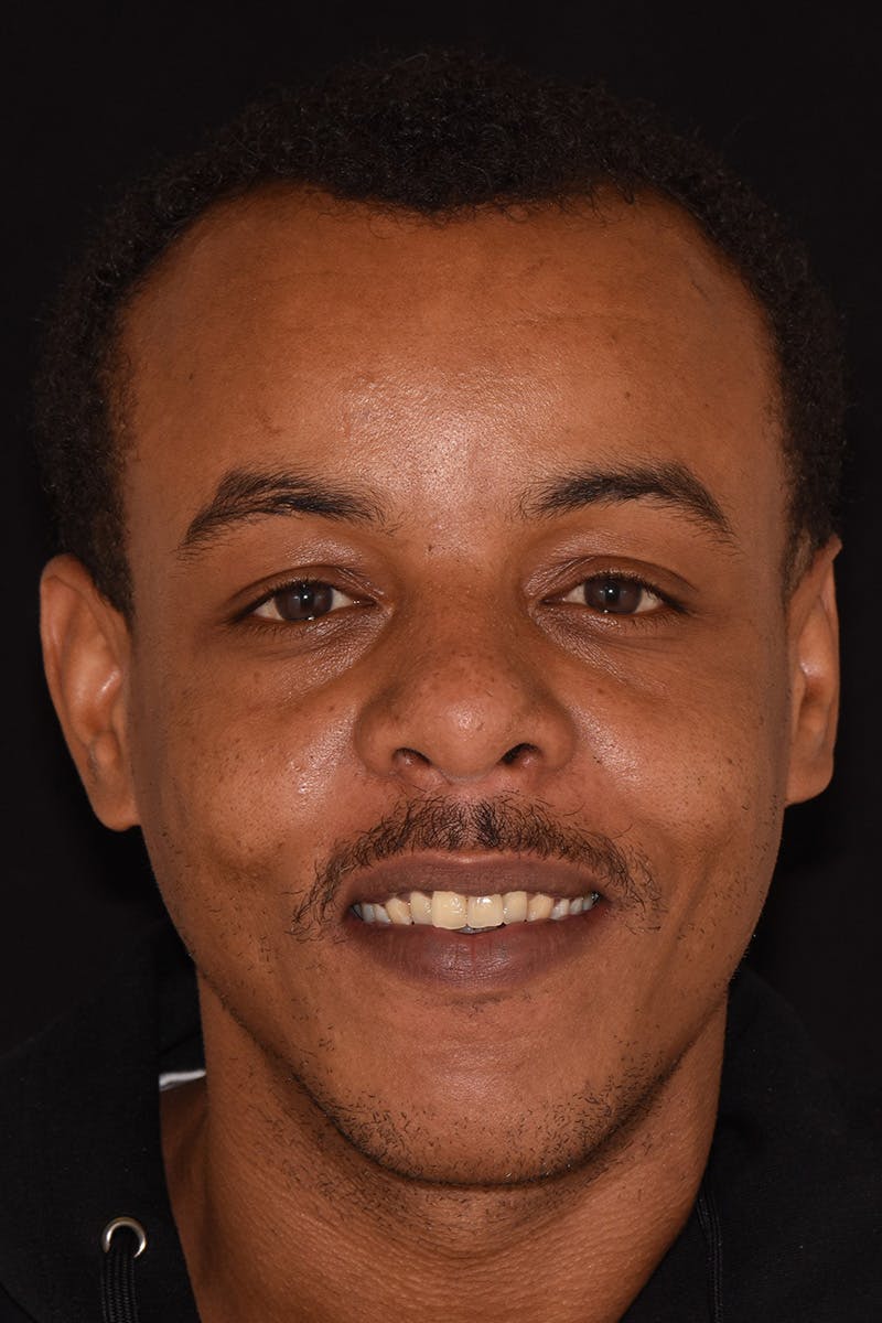 Patient Smile Before & After Gallery - Patient 428130 - Image 1