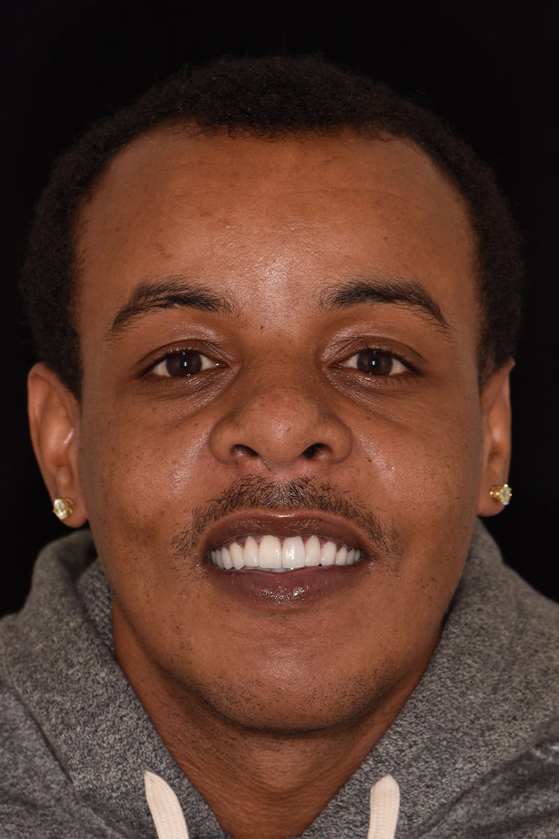 Patient Smile Before & After Gallery - Patient 428130 - Image 2