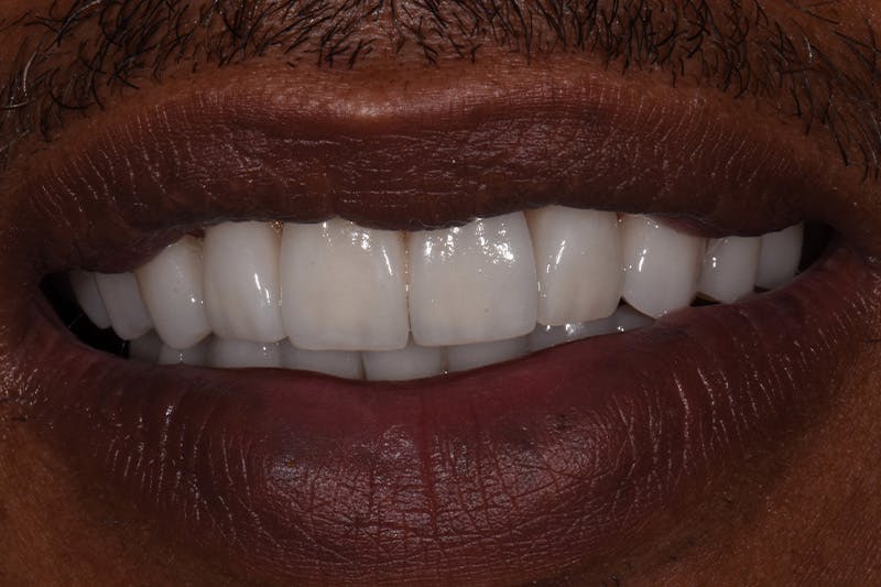 Patient Smile Before & After Gallery - Patient 428130 - Image 4