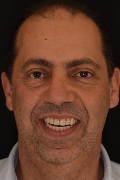 Patient Smile Before & After Gallery - Patient 167496 - Image 2