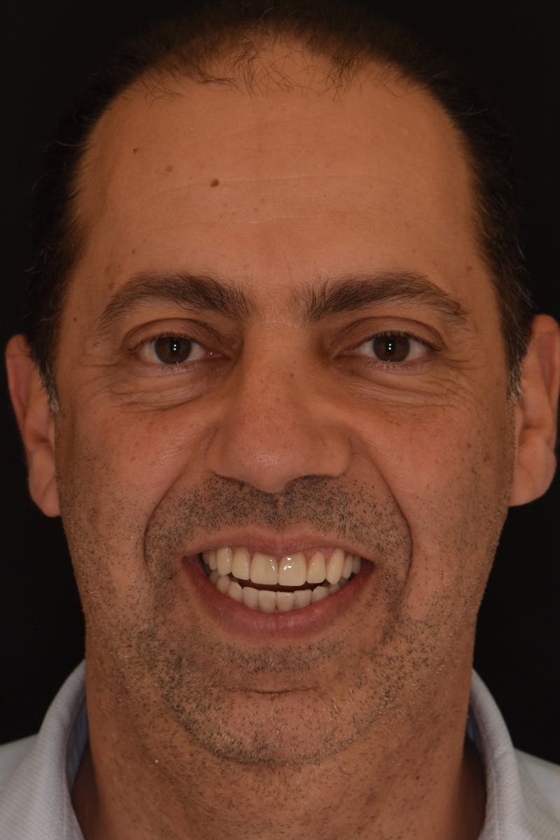 Patient Smile Before & After Gallery - Patient 167496 - Image 2