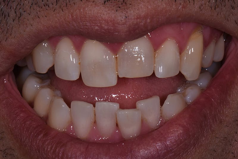 Patient Smile Before & After Gallery - Patient 167496 - Image 3