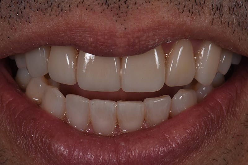 Patient Smile Before & After Gallery - Patient 167496 - Image 4